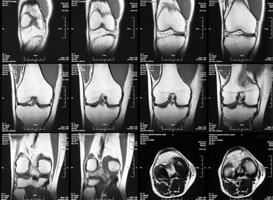膝痛の原因を調べるMRI検査